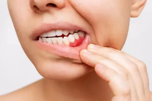 Gum Disease South Huntington NY | Dentistry By Design, PC