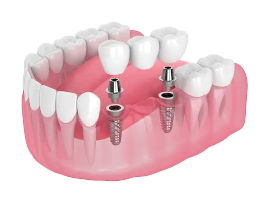 Common Questions about Dental Bridges South Huntington NY | Dentistry By Design PC | Restorative Dentist Huntington area