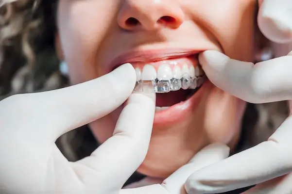 Why Choose Invisalign®?  Victoria Road Dental Clinic