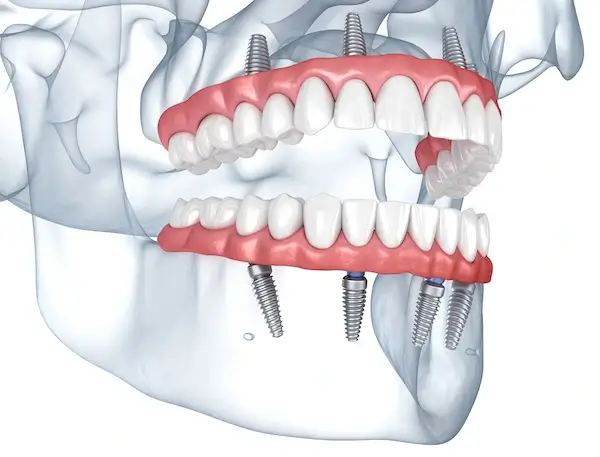 All-On-4 Dental Implants South Huntington & Melville NY | Dr. Joseph Ayoub