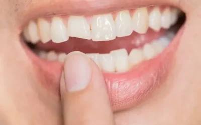 Treatment Options For A Chipped Tooth